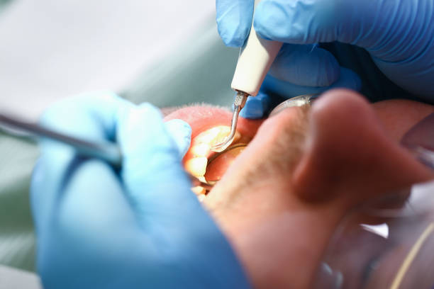 Best Broken or Chipped Tooth Repair in Quincy, WA